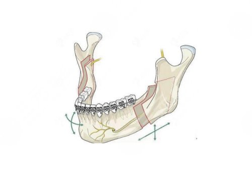 蘇大附一院正頜手術(shù)價格