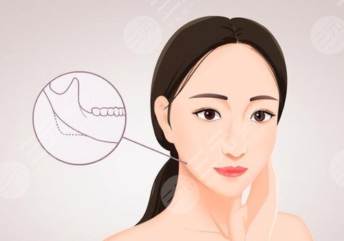 上海時(shí)光做下頜角怎么樣