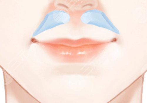 李勁良醫(yī)生鼻基底是用膨體嗎