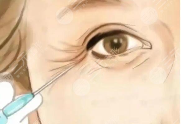 魚(yú)尾紋注射