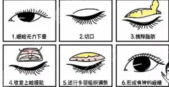 雙眼皮修復(fù)