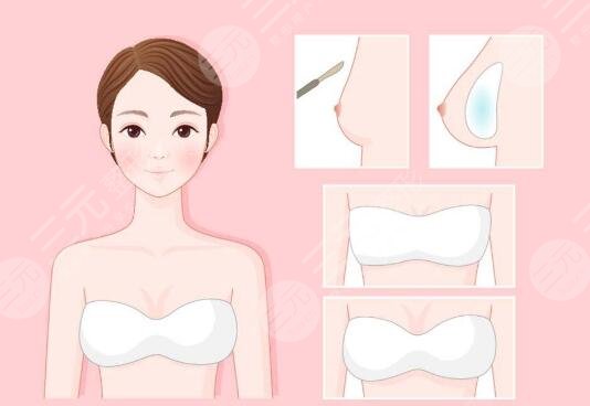 自體脂肪豐胸