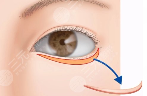 眼瞼整形
