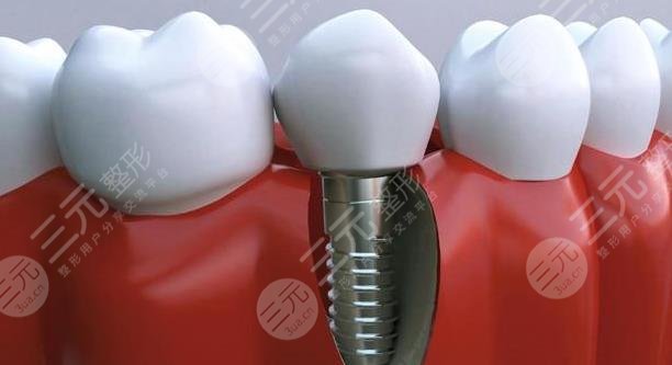 牙齒種植