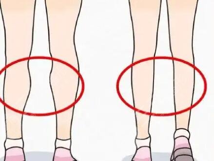 腿型矯正