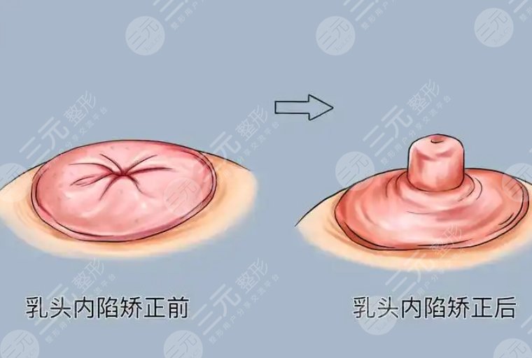 乳頭內(nèi)陷