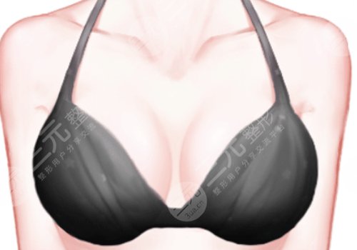 北京協(xié)和醫(yī)院豐胸價(jià)格