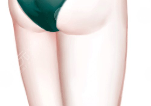 廣醫(yī)一院抽脂價格