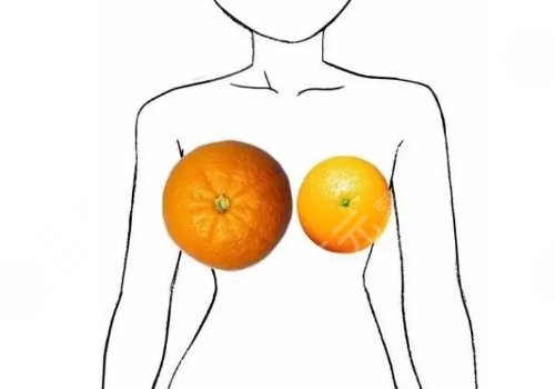 2025浙大二院易成剛縮胸手術(shù)多少錢