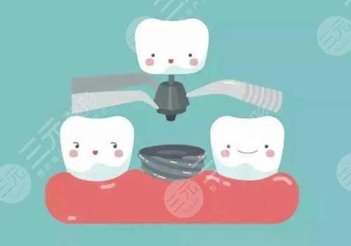 上海九院種牙的價(jià)格一般都是多少錢