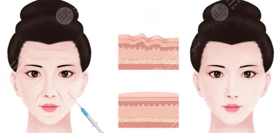 注射除皺