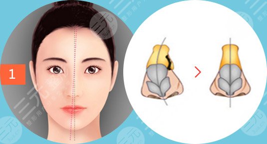 歪鼻矯正手術(shù)核心解析