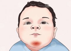 膠原蛋白墊下巴危害，醫(yī)美小白最容易踩的坑，疼三天，悔三年？