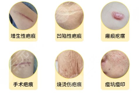 祛疤