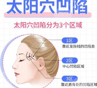 豐太陽(yáng)穴、